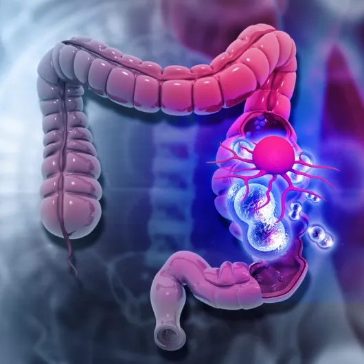 Colorectal Cancer Symptoms