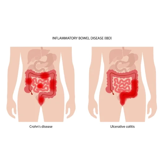 Type of IBD