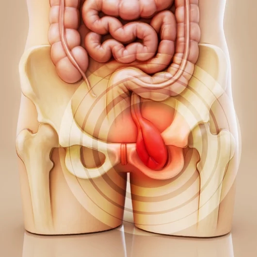 Inguinal Hernia Causes