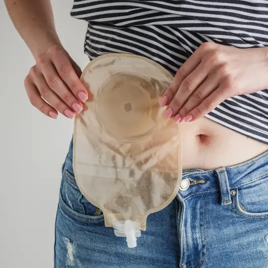 Living with a Stoma