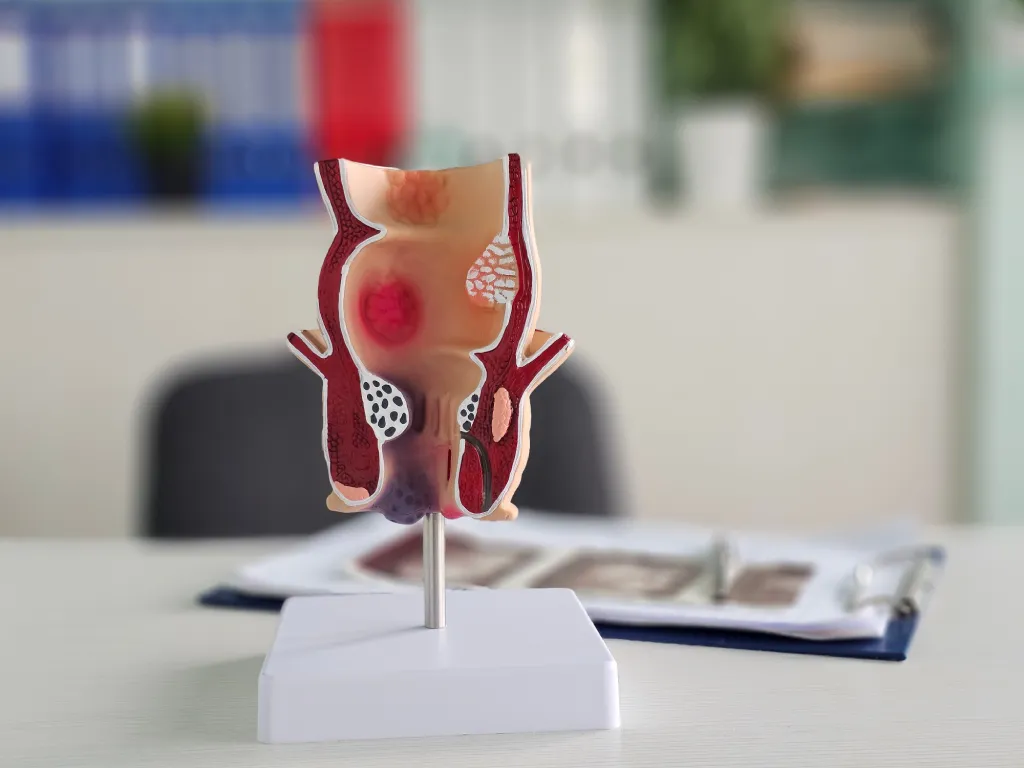 Pembedahan Fistula Ani di Singapura