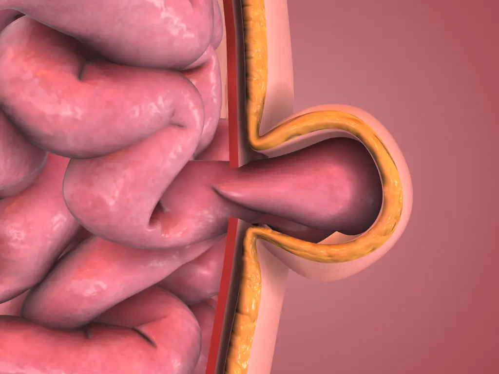 Ventral Hernia