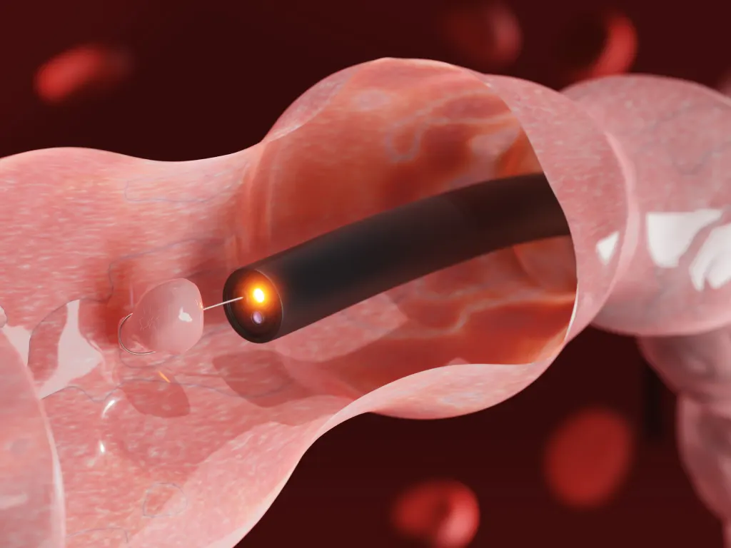 Colonoscopy Procedure