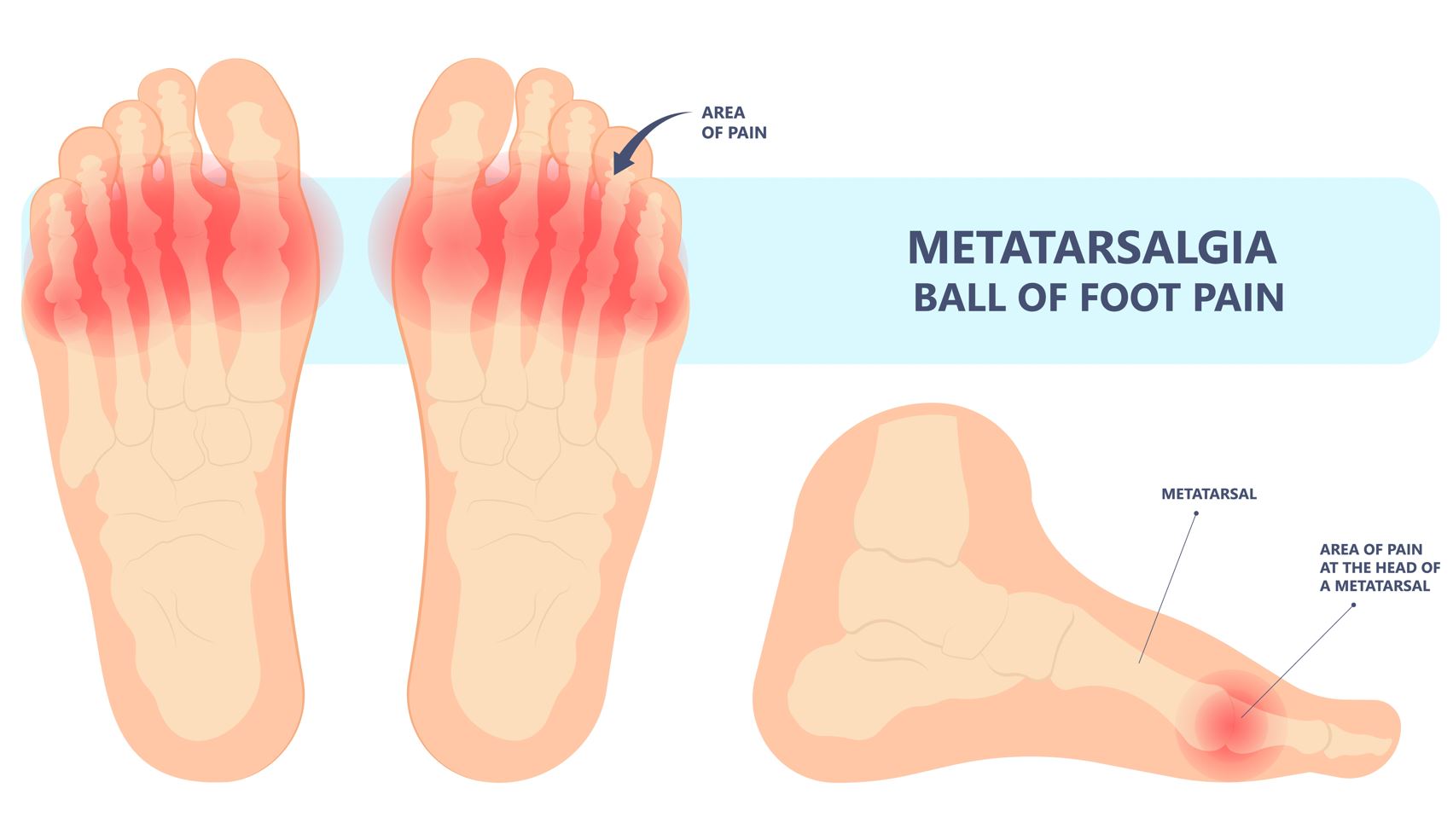 What is metatarsalgia? Why is my ball of the foot painful? Straits Podiatry Singapore.